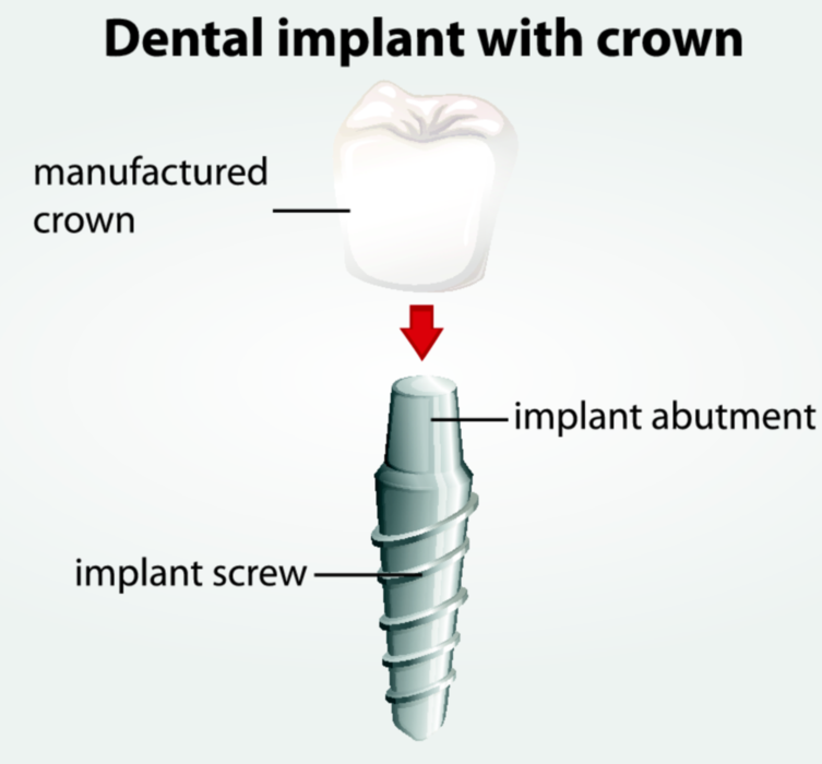 Dental Implants in Irvine CA