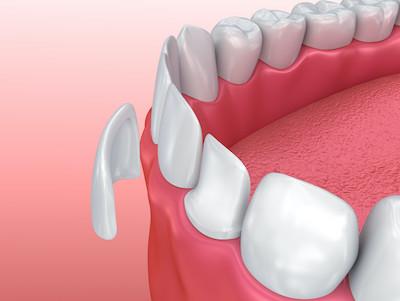 porcelain veneers