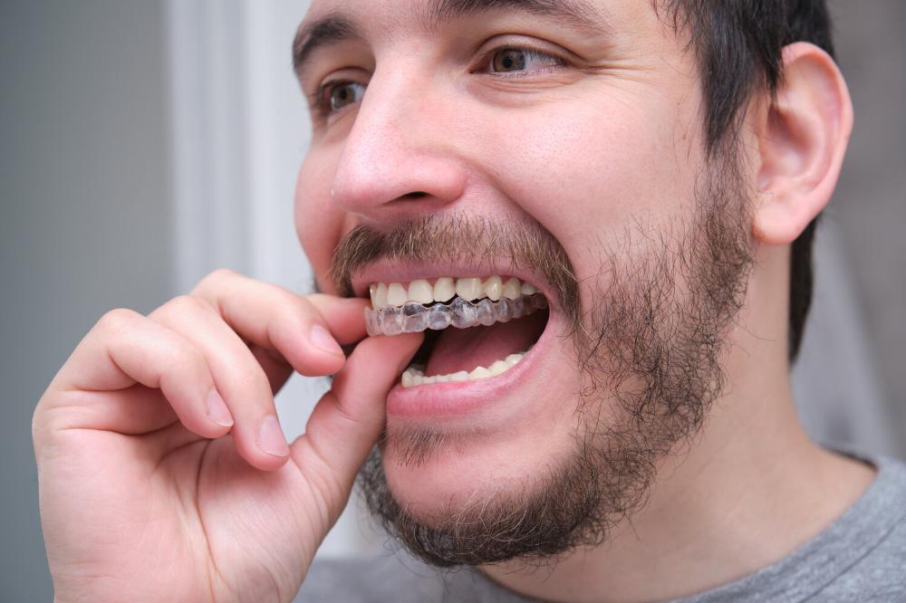 man putting invisalign aligners in