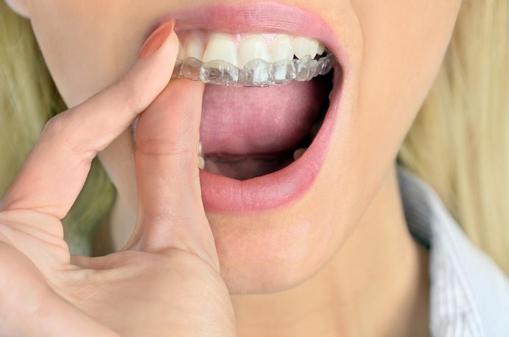 close up of woman putting Invisalign into her mouth