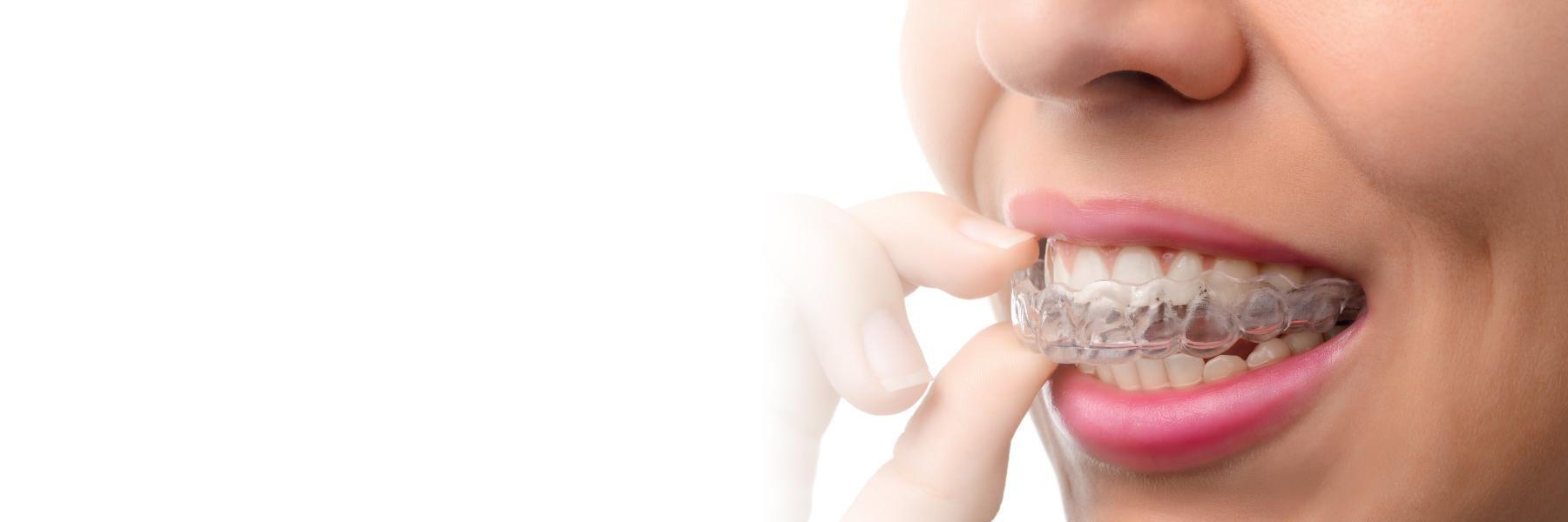 clear braces | dentist in irvine ca