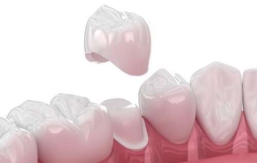 crown on tooth