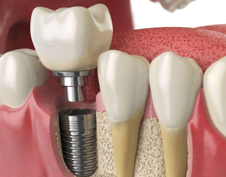dental implant with crown on top