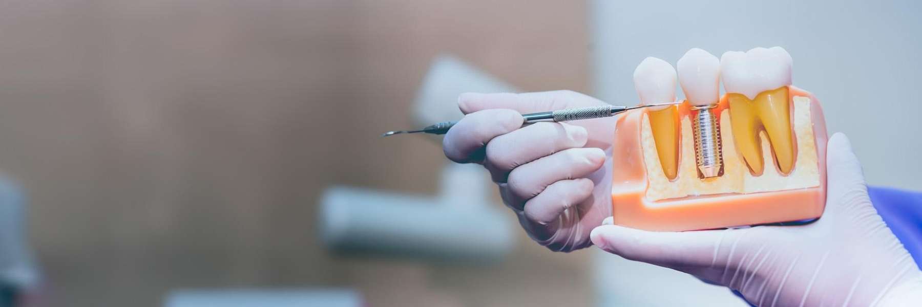 dental implants