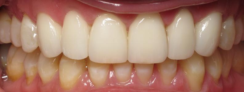 teeth with a full set of upper dental veneers