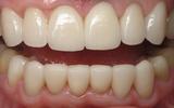 teeth that have a full set of new dental veneers