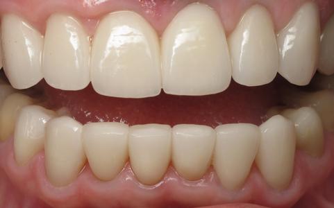 teeth that have a full set of new dental veneers