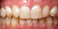 image of chipped teeth upper and lower