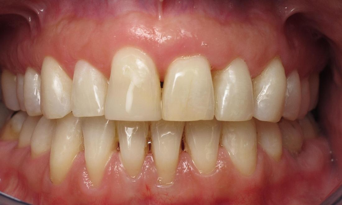 dental bonding to fill gap in teeth | irvine ca