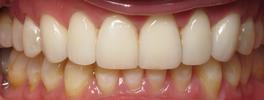 teeth with a full set of upper dental veneers
