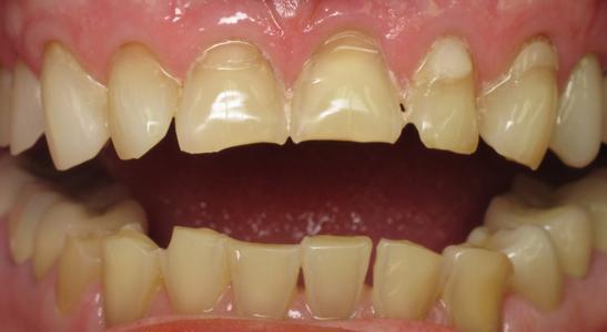 teeth that are chipped and slightly stained