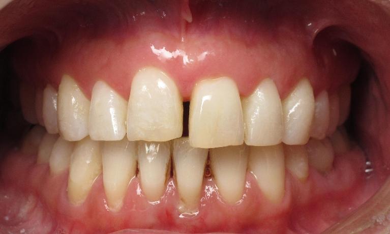 dental bonding to fill gap in teeth | irvine ca